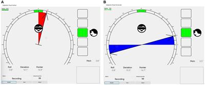 Evaluation of subjective visual vertical and horizontal in patients with acoustic neuroma based on virtual reality